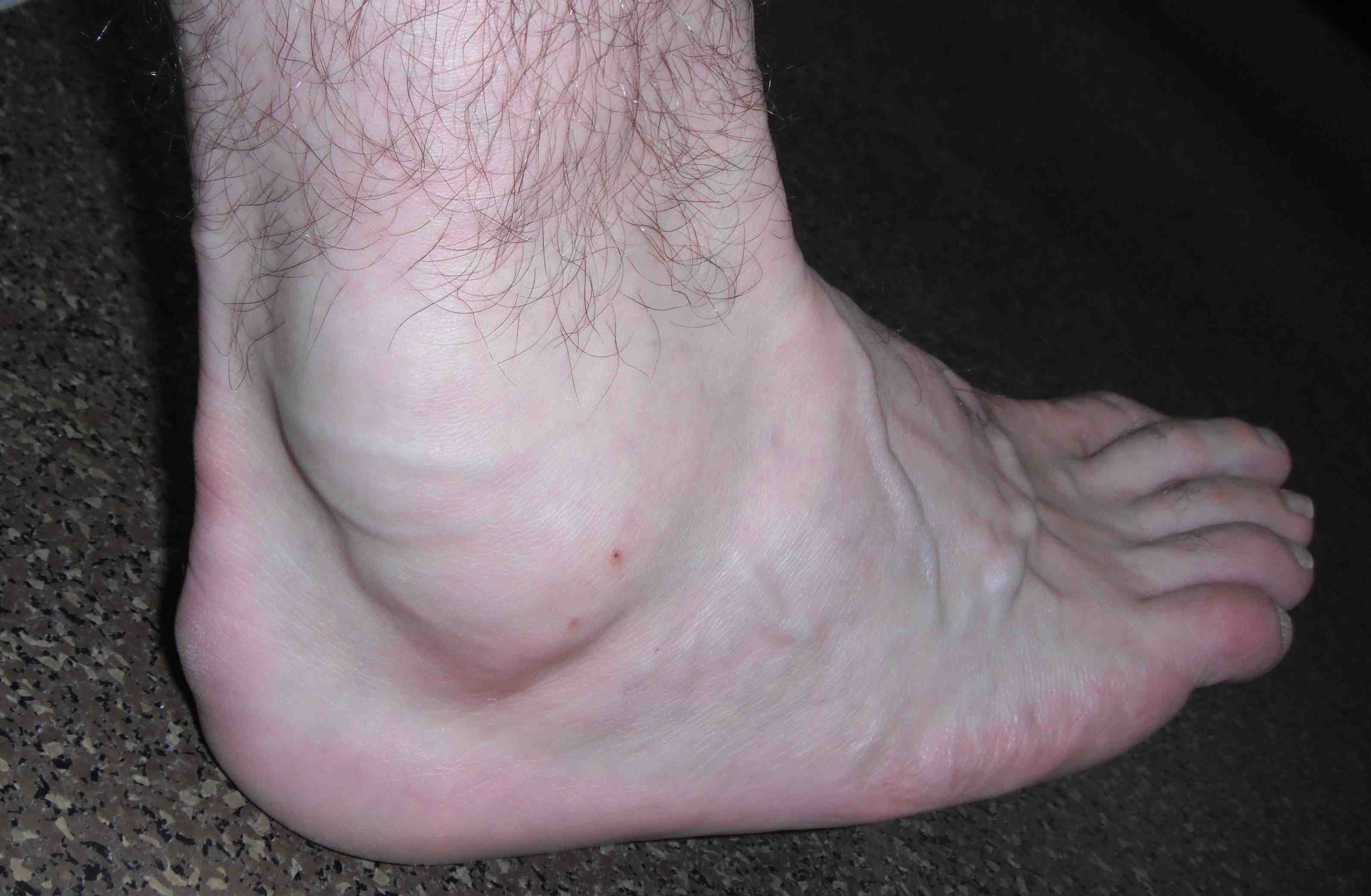 Peroneal Tendon Swelling